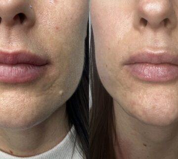 "استكشف تقنية الفراكشنال ليزر، الحل الأمثل لمشاكل البشرة مثل التجاعيد وندبات حب الشباب. تعرف على فوائدها، آثارها الجانبية، ونصائح العناية بالبشرة بعد العلاج للحصول على نتائج مذهلة."