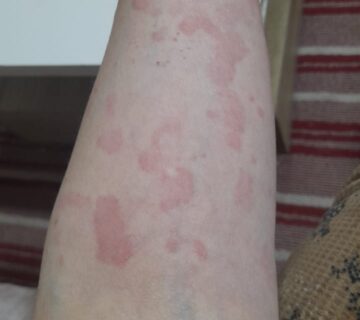 الحساسية الحادة من المشكلات الصحية التي يعاني منها العديد من الأشخاص حول العالم